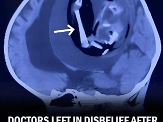 Doctors Shocked After Discovering Fetus Growing in Infant’s Skull