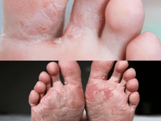 7 Easy Home Remedies to Treat Foot Fungus