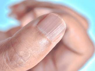 Understanding the Real Causes of Vertical Ridges on Your Nails