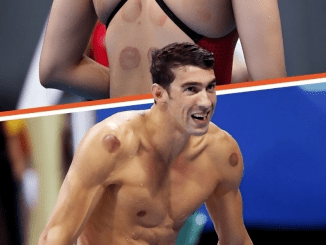 Why Were Olympic Athletes & Other Celebs Spotted with Dark Red Circles on Their Bodies?