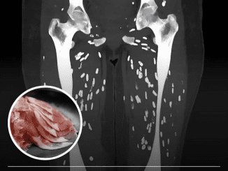 Doctor shares horrifying scan showing patient’s legs after eating undercooked pork