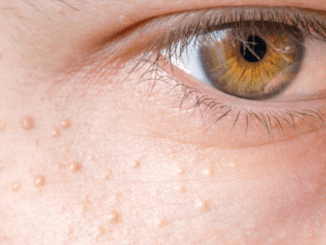 If You Have These Tiny, White Bumps on Your Face, Don’t Try to Remove Them!