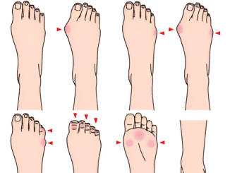 10 Ways Your Feet Are Telling You Something About Your Health