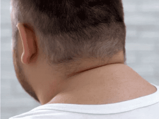 Got a buffalo hump on your neck? Here’s what it means and what you should do