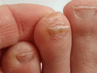 My nana swears by this trick to reduce the look of thick toenails. Here’s how it works