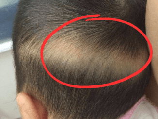 If your child’s hair falls out in an arc like this, don’t ignore it