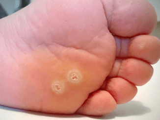 My nana swore by this trick to remove her warts overnight. Here’s how it worked