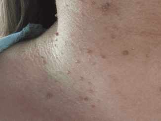 What are the best natural ways to remove moles from the skin?