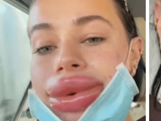 Woman shares her ‘cosmetic nightmare’ after winning free lip fillers