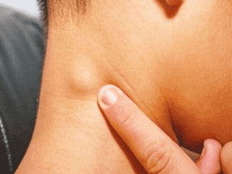 Lumps on Body: What Do Neck Lumps Mean?