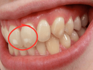 If your teeth have white spots like this, go to the dentist immediately